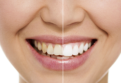 Zahnarztpraxis Dr. Dietl: Bleaching