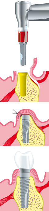 Zahnarztpraxis Dr. Dietl: Implantologie