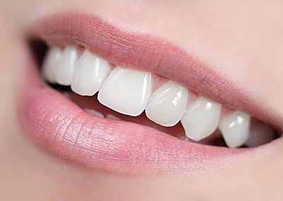 Zahnarztpraxis Dr. Dietl: Veneers